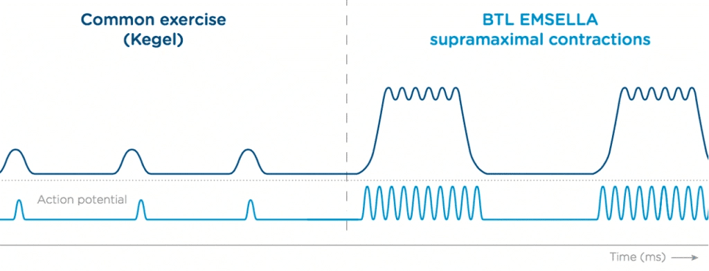 Graph showing the number of muscle contractions between common excercise (kegels) and using the BTL Emsella (which triggers supramaximal contractions). The former induces much less muscle contractions than the latter.