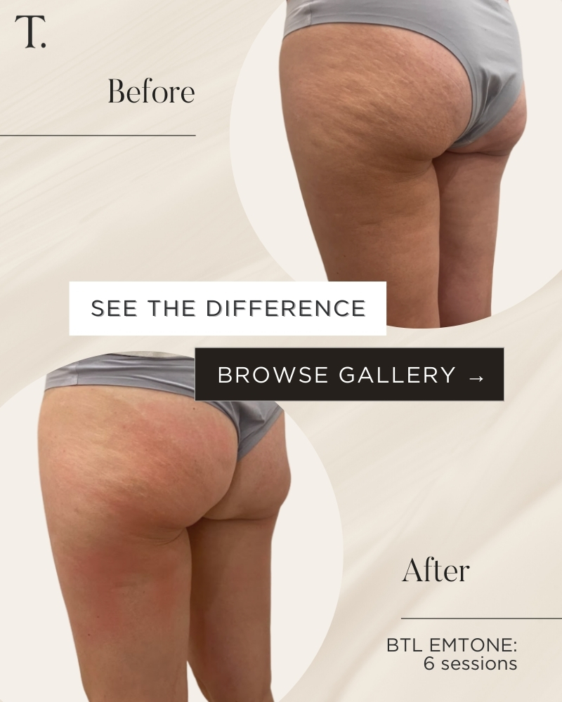 Before & After Cellulite Reduction Treatment with BTL EMTONE