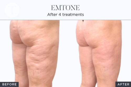 BTL EMTONE - Before and After Photos for Cellulite Reduction