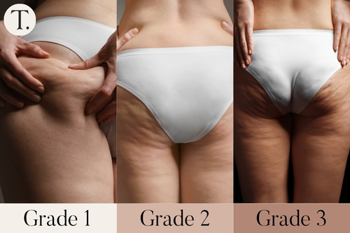 Grades of Cellulite Severity: - Grade 1 - Mild cellulite: Dimpling when pressure is applied
- Grade 2 - Moderate cellulite: Visible dimpling when standing, but not when lying down.
- Grade 3 - Severe cellulite: Dimpling when both standing and lying down.