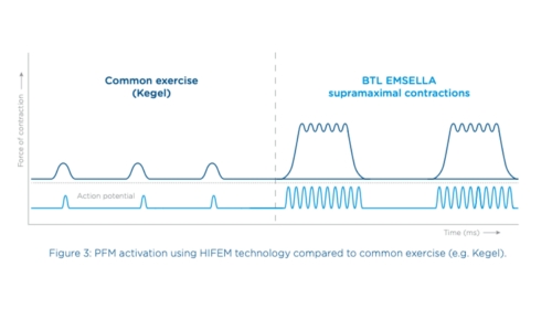 Diagram comparing Pelvic Muscle Contractions between Kegel exercises and BTL EMSELLA