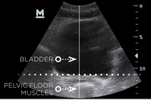 Stimulated Pelvic Floor
(After Emsella)