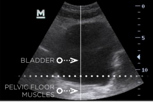 Relaxed & Loosened Pelvic Floor
(Before Emsella)