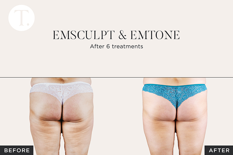 Cellulite Reduction Treatment Quick Cellulite reduction results