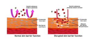 Comparison of normal versus disrupted skin barrier function.