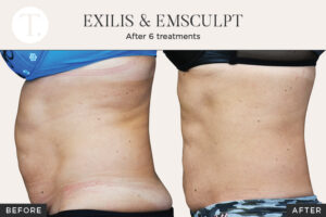 Figure 1 - Exilis and Emsculpt, after six treatments.
