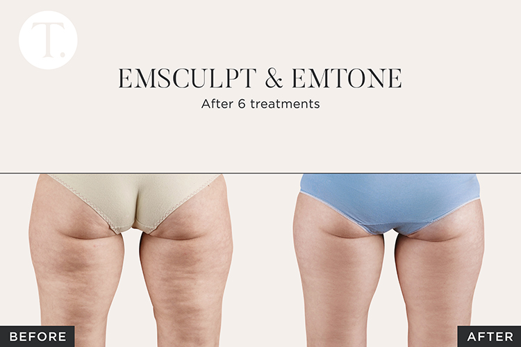 Cellulite Reduction Treatment Quick Cellulite Reduction Results