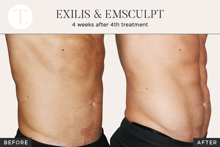Figure 2 - Exilis and Emsculpt, after four treatments.