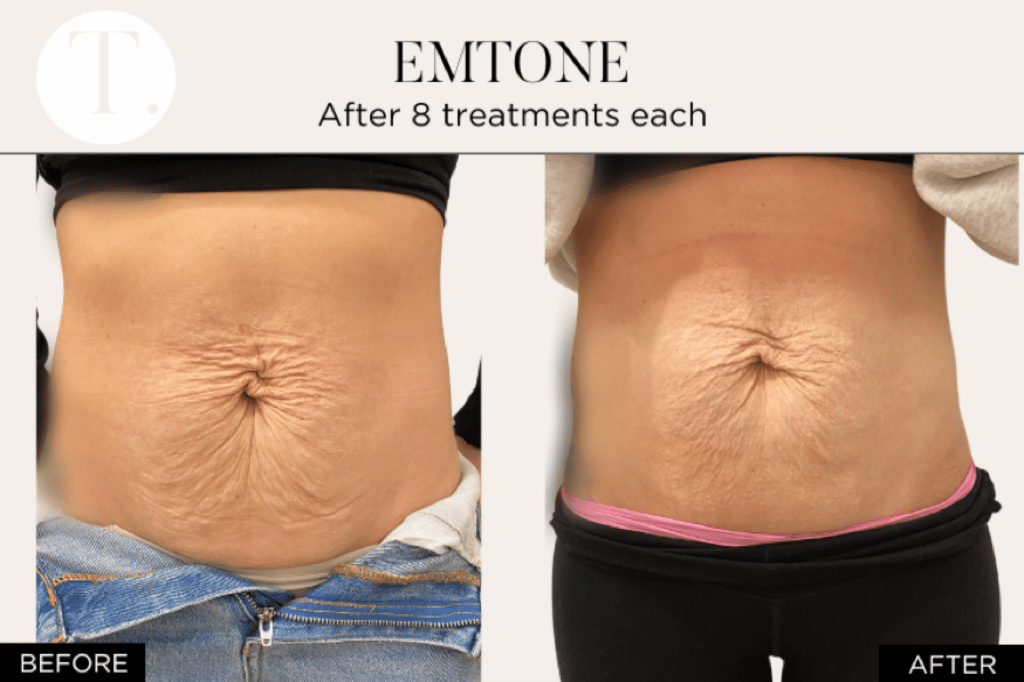 Before and after results of Skin Tightening treatment with 8 sessions using EMTONE