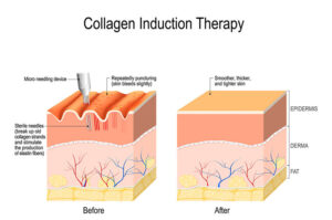 Skin Needling (Collagen Induction Therapy) Diagram